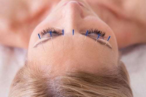 Detail Of A Woman Receiving An Acupuncture Needle Therapy