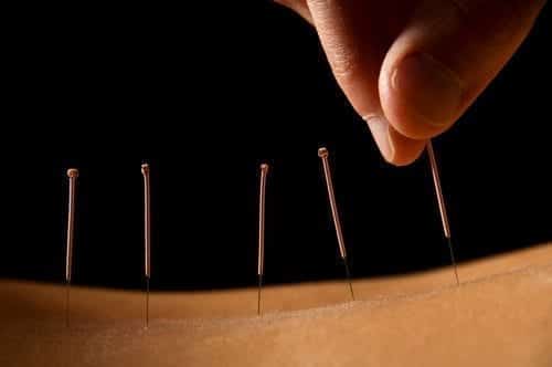 Woman getting an acupuncture treatment in a spa