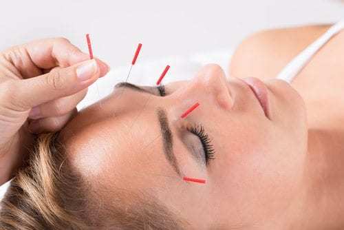 Hand Performing Acupuncture Therapy On Head